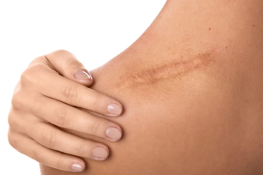 Terapia blizny
